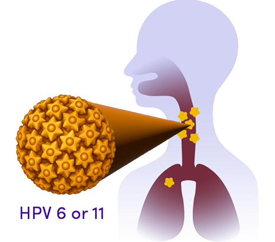 Graphic demonstrating how HPV 6 & 11 are the root causes of RRP.